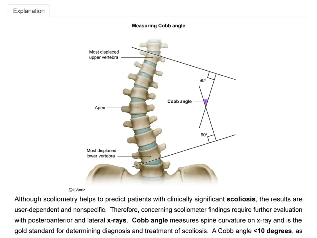UWorld Step 3 challenging practice question & explanation highlighting Measuring Cobb Angle
