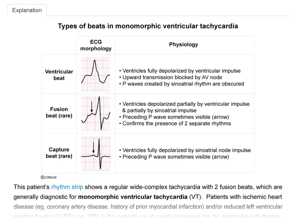 UWorld Step 2 practice question & detailed explanation featuring Monomorphic ventricular tachycardia
